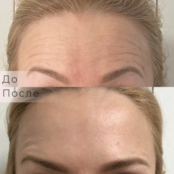 Ботокс/ ботулинотерапия
                    Косметолог Анастасия Одесса