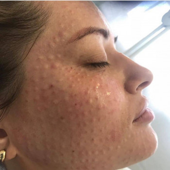 Папулы остаются на лице от 1 до 3х дней