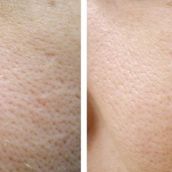 5 процедур биоревитализации