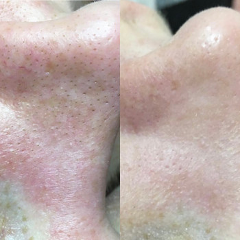 Чистка лица
                    Косметолог Анастасия Одеса