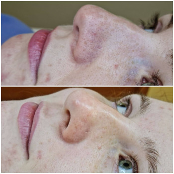 Чистка лица
                    Косметолог Анастасия Одеса