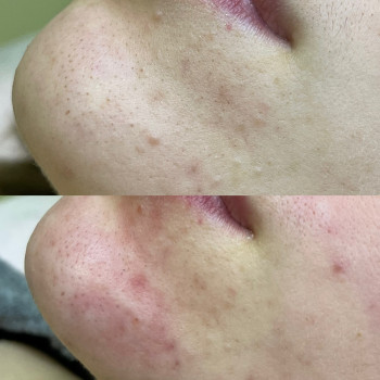 Чистка лица
                    Косметолог Анастасия Одеса