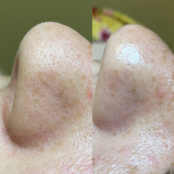 Чистка лица
                    Косметолог Анастасия Одеса