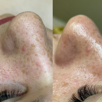 Чистка лица
                    Косметолог Анастасия Одеса