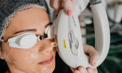 Lumenis M22 Лікування куперозу (зона щік) Косметологический центр Beauty Laser Чернигов