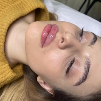 Збільшення губ
                    Косметолог-ін'єкціоніст Татьяна Чернівці