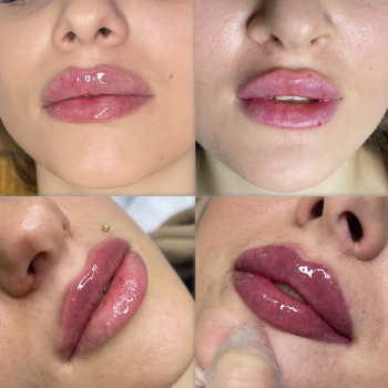 Збільшення губ
                    Косметолог-ін'єкціоніст Татьяна Чернівці