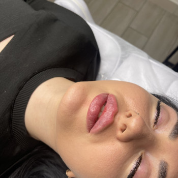 Збільшення губ
                    Косметолог-ін'єкціоніст Татьяна Чернівці