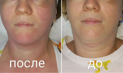 Криолиполиз апликатор подбородка Косметологический центр Beauty Laser & EndoSpheres Therapy Киев