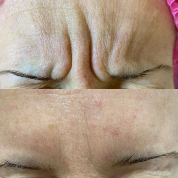 Ботулинотерапия межбровной морщины