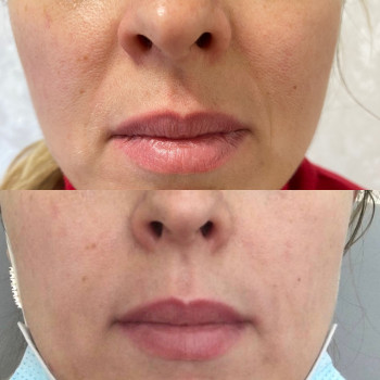 Заполнение носогубных складок