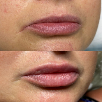 Контурная пластика губ, выравнивание асимметрии