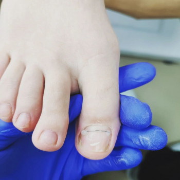 Ортонексия (лечение вросших ногтей)
                    Подолог Максимилиан Суми