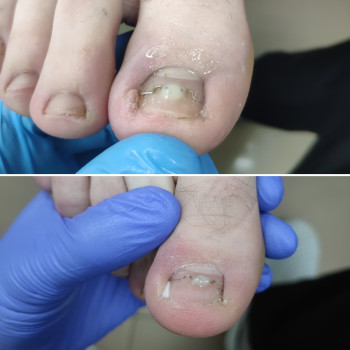 Ортонексия (лечение вросших ногтей)
                    Подолог Максимилиан Суми