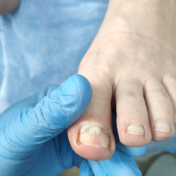 Ортонексия (лечение вросших ногтей)
                    Подолог Максимилиан Суми