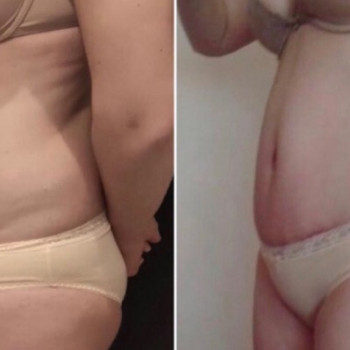 Абдоминопластика 
ДО  ПОСЛЕ