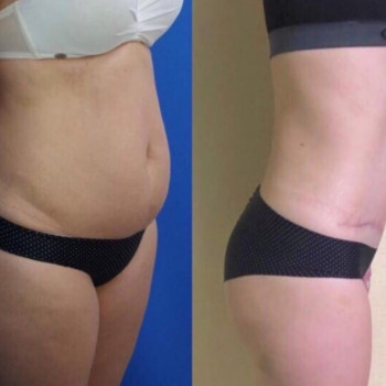 Абдоминопластика с транспозицией пупка и ушиванием белой лин