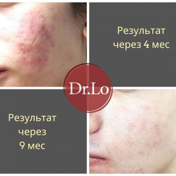 Лечение шрамов после акне