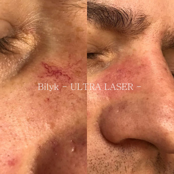 Лазерні видалення куперозу(судинної сітки) в ділянці обличчя