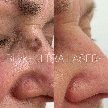 Лазерне видалення керамоми. Результат з інтервалом в 3 тижні