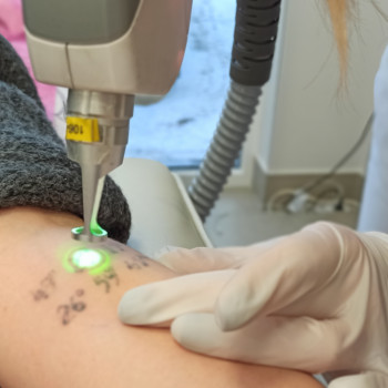 Лазерне видалення татуювань.