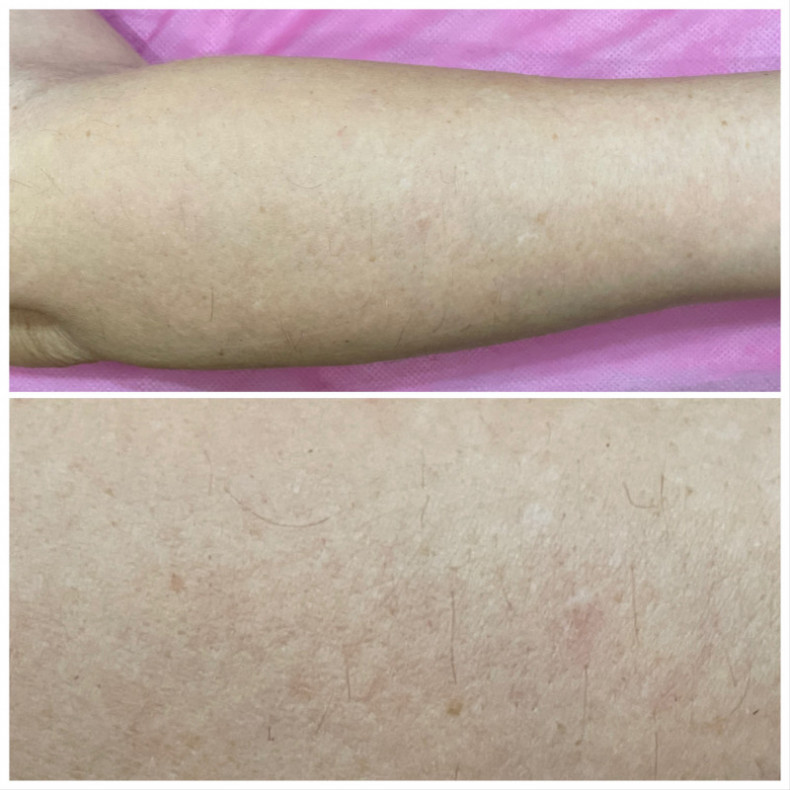 Лазерная эпиляция рук, спустя 5 сеансов., фото - Мастер депиляции Евгения Федирко