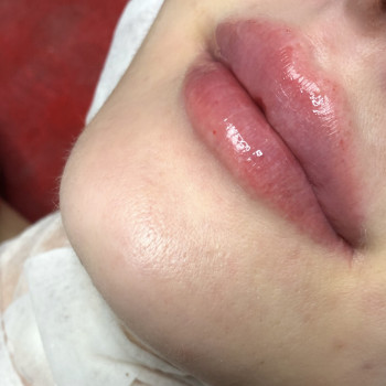 Контурна пластика губ