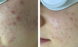 Lumenis M22 лечение акне лицо + шея Косметологічний центр Beauty Laser & EndoSpheres Therapy Київ