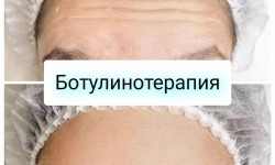 Ботулинотерапия лба (Botox Allergan) Врач-косметолог Кристина Одесса