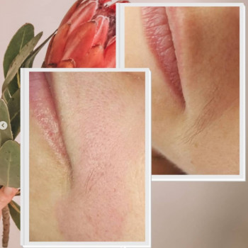 Лазерная эпиляция для мужчин и женщин
                    Косметологический центр BB Studio Киев