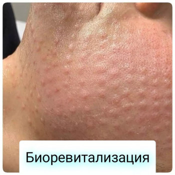 Биоревитализация (Saypha Rich)
                    Врач-косметолог Кристина Одесса