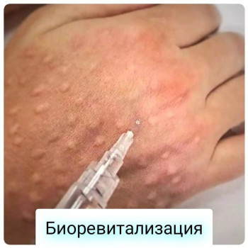 Биорепарация (Aquashine BTX)
                    Лікар-косметолог Кристина Одеса
