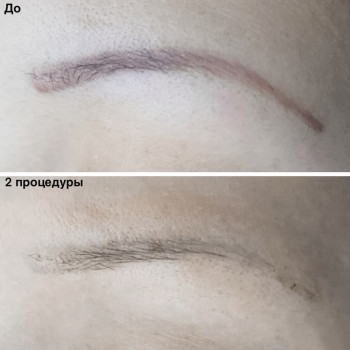 Удаление татуажа ремувером
                    Майстер перманентного макіяжу Ксения Кобылянская Київ