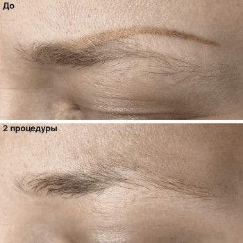 Удаление татуажа лазером
                    Майстер перманентного макіяжу Ксения Кобылянская Київ