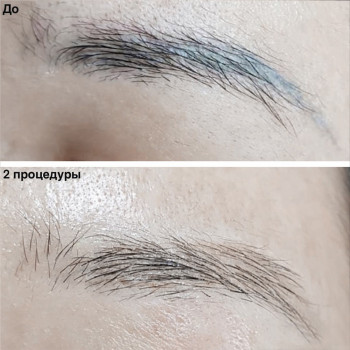 Удаление татуажа лазером
                    Майстер перманентного макіяжу Ксения Кобылянская Київ