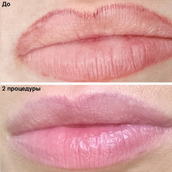 Удаление татуажа лазером
                    Майстер перманентного макіяжу Ксения Кобылянская Київ