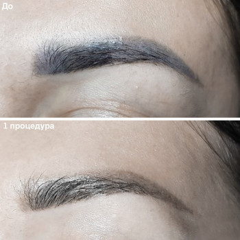 Удаление татуажа лазером
                    Майстер перманентного макіяжу Ксения Кобылянская Київ