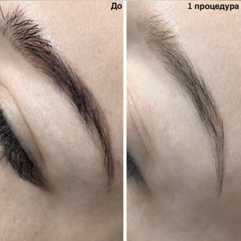 Удаление татуажа лазером
                    Майстер перманентного макіяжу Ксения Кобылянская Київ