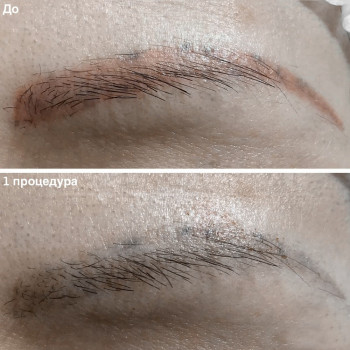 Удаление татуажа лазером
                    Майстер перманентного макіяжу Ксения Кобылянская Київ