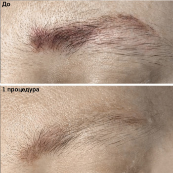 Удаление татуажа лазером
                    Майстер перманентного макіяжу Ксения Кобылянская Київ