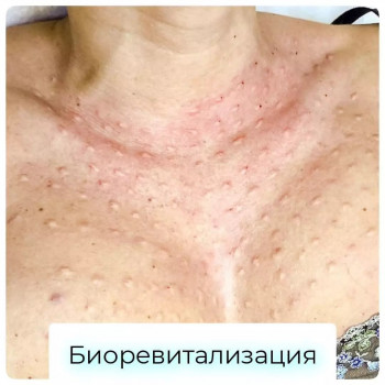коррекция морщин, уколы в лицо, косметология тела