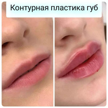 Контурная пластика губ (Saypha Filler)
                    Косметологический центр GENETIX Одесса