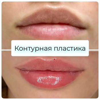 Контурная пластика губ (Saypha Filler)
                    Косметологический центр GENETIX Одесса