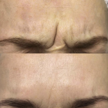 Ботулинотерапия
                    Косметолог Анастасия Одесса