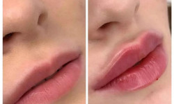 Контурная пластика губ (Juvederm Ultra3) Косметологический центр GENETIX Одесса