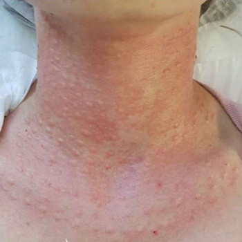 биоревитализация шеи