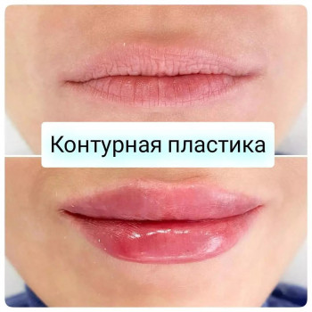 Контурная пластика губ (Juvederm Volift Retouch)
                    Лікар-косметолог Кристина Одеса
