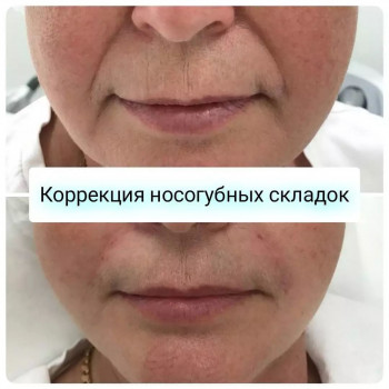 Коррекция носогубных складок (Belotero Intense)
                    Лікар-косметолог Кристина Одеса