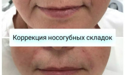 Коррекция носогубных складок (Belotero Intense) Врач-косметолог Кристина Одесса