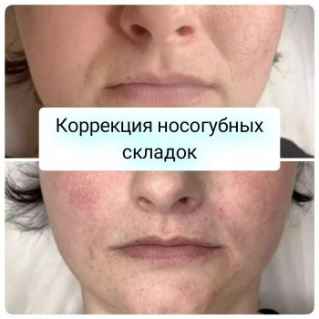 Коррекция носогубных складок (Belotero Intense)
                    Лікар-косметолог Кристина Одеса